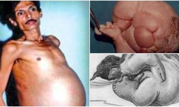 Người đàn ông mang trong mình 'thai chết lưu' suốt 36 năm, bào thai nặng 4kg, có cả tóc và tay chân 