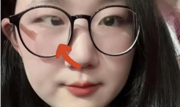 Cô gái bỗng nhiên bị lác mắt vì thú vui của nhiều người