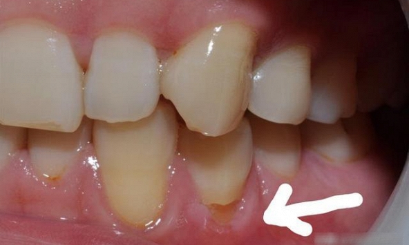 Răng vỡ rụng từng mảng vì cách đánh răng sai nhiều người mắc