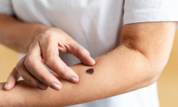 4 bộ phận trên cơ thể chuyển màu đen sạm cảnh báo tế bào ung thư