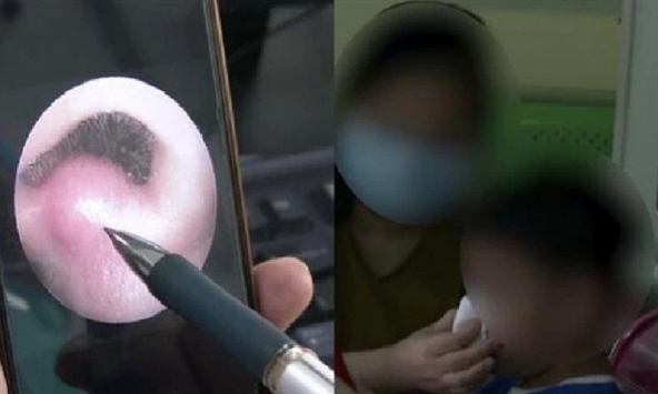 Bé 8 tuổi nhiễm trùng nội sọ, suýt mất mạng vì 1 thói quen khi rảnh rỗi