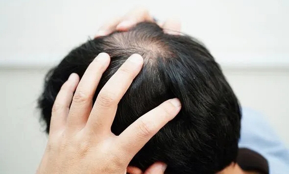 Rụng lông tóc ở ba vùng trên cơ thể có thể là dấu hiệu của bệnh truyền nhiễm