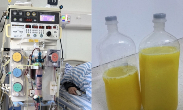 Lọc ra 2 chai 'mỡ' đục ngầu từ máu người phụ nữ, tất cả do một món ngon yêu thích mỗi ngày