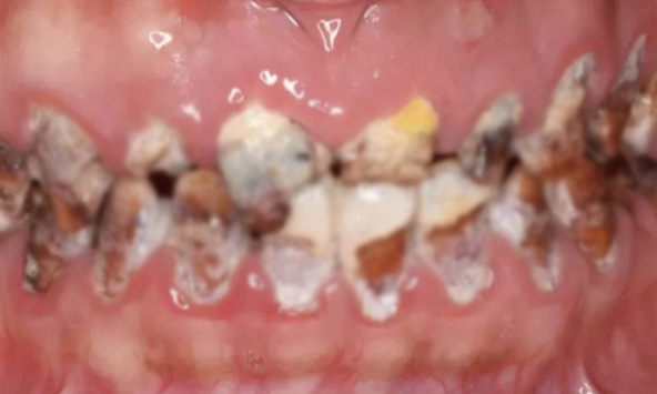 Cô gái mới 22 tuổi cả hàm răng đã đen kịt, ăn đồ mềm cũng rụng răng vì loại đồ uống người trẻ yêu thích