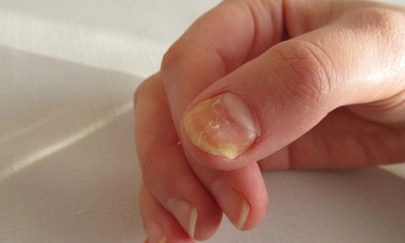 Người thiếu sắt nhìn vào móng tay thấy ngay 3 điểm, hãy mau tự kiểm tra