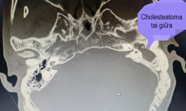 Vi khuẩn phá hủy xương tai giữa, xâm nhập vào não, người đàn ông hối hận vì từng xem nhẹ bệnh