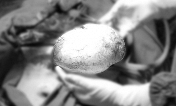 Nữ sinh 17 tuổi ở Phú Thọ đau bụng dưới suốt 1 tuần, gia đình sửng sốt sau khi đưa đi khám