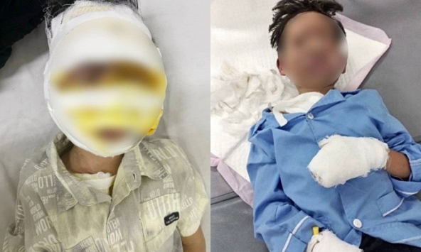 Lại thêm một bé trai 8 tuổi bỏng hoàn toàn vùng mặt do laptop phát nổ