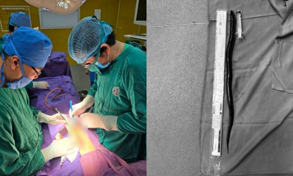 Bác sĩ hãi hùng phát hiện con lươn dài 30 cm trong ổ bụng bệnh nhân khiến một phần trực tràng bị hoại tử, phải làm hậu môn nhân tạo