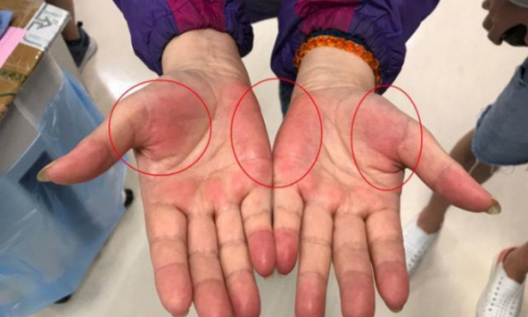 “2 đỏ, 2 ngứa, 2 hôi” cho thấy ung thư gan đã bắt đầu tàn phá cơ thể, nên đi khám ngay