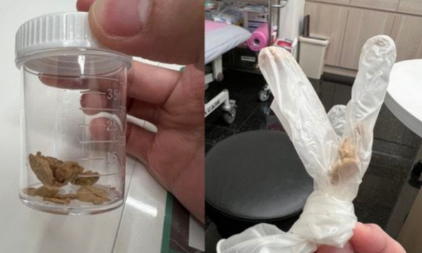 Người đàn ông hoảng hốt vì cậu nhỏ rơi ra toàn “đá”, hóa ra quên làm 1 việc suốt 30 năm