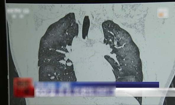 Chàng trai 20 tuổi phổi trắng xóa vì 'chiêu' chống nắng của nhiều người