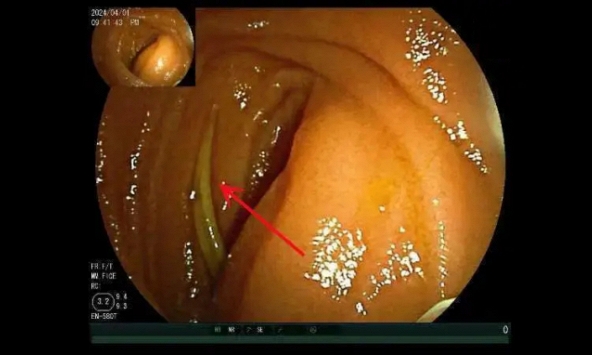 Đau bụng không chịu nổi, nữ bệnh nhân bị vật lạ đâm thủng ruột
