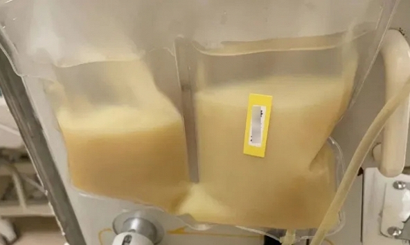 Chàng trai 30 tuổi máu trắng sệt 'như sữa đặc', món ăn yêu thích của nhiều người là thủ phạm