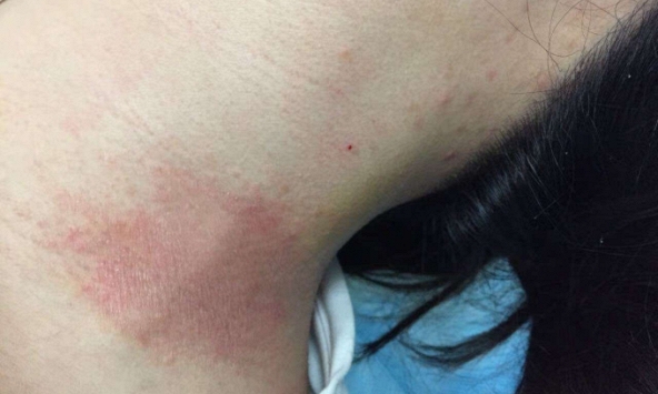 Người phụ nữ bỏng nặng sau khi tắm, bác sĩ nhắc đừng có thói quen tắm rửa này