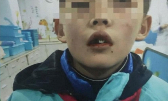 Nam sinh ngã rụng 5 chiếc răng, cốc sữa tươi của giáo viên trở thành 'vật cứu mạng'