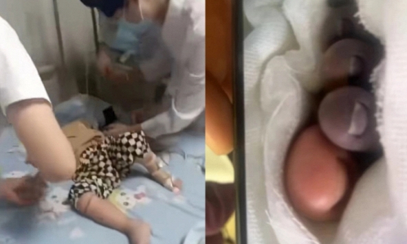 Bé trai 2 tuổi nhiễm vi khuẩn ăn thịt người, phải cắt cụt chi vì nghịch cá ở chợ