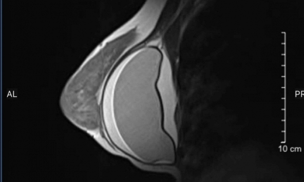 Bệnh viện Đại học Y Hà Nội liên tục tiếp nhận nhiều trường hợp vỡ túi nâng ngực