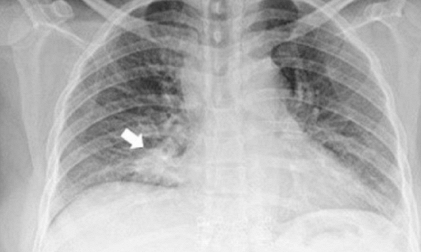 Người phụ nữ phát hiện ung thư phổi ẩn giấu nhờ 1 dấu hiệu ở mắt 