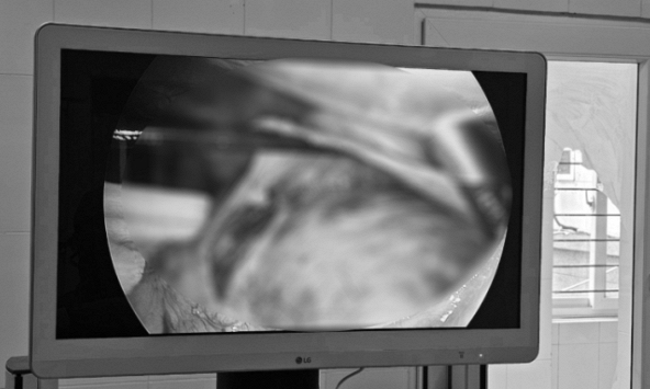 Đau tức hông lưng, nội soi người đàn ông thấy nhiều thứ này 'bao vây, chèn ép' 2 quả thận