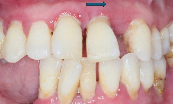 Bác sĩ cảnh báo thói quen nhiều người cứ ăn xong là làm, khiến răng càng ngày càng thưa, thậm chí làm teo nướu