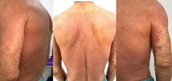 Dùng dung dịch sát khuẩn, người đàn ông phát ban đỏ thẫm khắp cơ thể