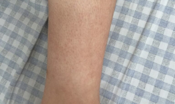 Người phụ nữ sốt cao, rải rác ban xuất huyết như đinh ghim 2 cổ chân, bác sĩ cảnh báo căn bệnh đang vào mùa