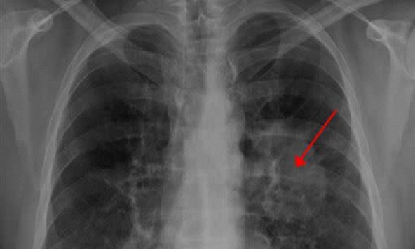 Người phụ nữ 37 tuổi qua đời sau 2 tuần phát hiện ung thư phổi, bác sĩ cảnh báo 1 dấu hiệu hầu hết mọi người đều bỏ qua
