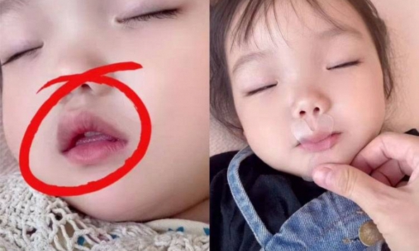 Thấy con gái 8 tuổi ngủ mở miệng, mẹ dùng băng keo dán khiến bé suýt ngạt thở, bác sĩ chỉ ra sai lầm