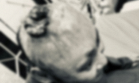 Đi khám vì vết thương lở loét không lành, bệnh nhân 26 tuổi được chẩn đoán ung thư 