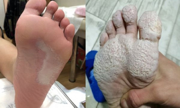 Bàn chân chàng trai lở loét trắng xóa, bốc mùi cá thối vì 1 hành vi khi đi giày rất nhiều người mắc phải