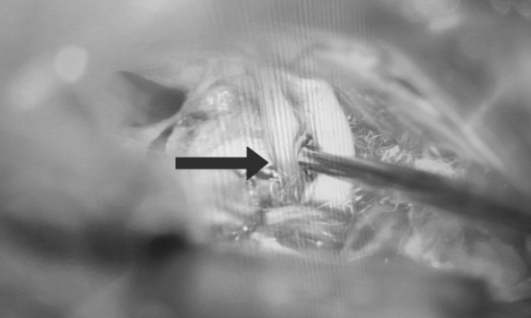 Người đàn ông bị co giật nửa mặt suốt 25 năm, bác sĩ chỉ cách phòng tránh bệnh