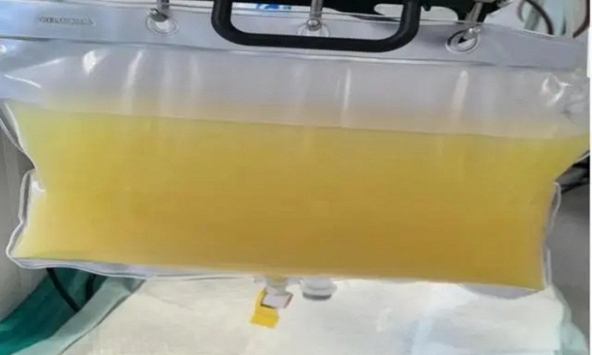 Rút ra 2 lít máu trắng như mỡ lợn từ người đàn ông, thủ phạm là 2 món khoái khẩu mùa hè