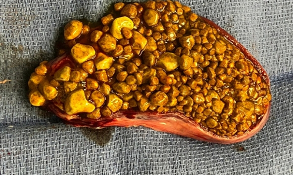 Người đàn ông phát hiện 5000 viên sỏi chất đầy trong túi mật do “1 thiếu, 1 thừa” khi ăn uống