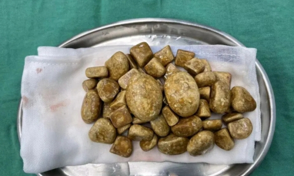 Lấy ra hơn 3kg sỏi từ bàng quang người đàn ông, nguyên nhân từ 'cái lười' tưởng vô hại của nhiều người