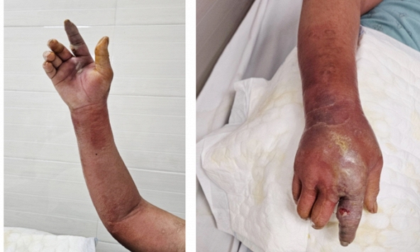 Bàn tay người đàn ông xuất hiện nhiều mụn mủ, rỉ dịch vàng sau khi bị chó cắn