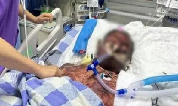 Người đàn ông bị tiêu chảy nặng, bầm tìm khắp người, suýt chết vì sai lầm khi sơ chế thịt lợn nhiều người mắc