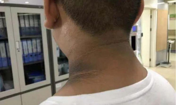 “6 đen, 2 hôi” trên cơ thể là dấu hiệu lượng đường trong máu tăng mất kiểm soát