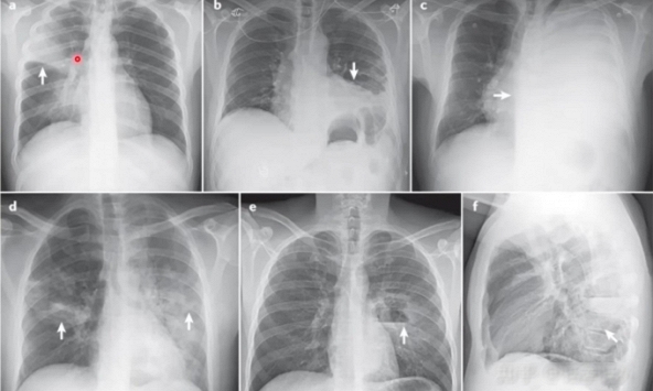 Bé gái 6 tuổi phổi chuyển sang màu trắng sau 3 ngày, bác sĩ cảnh báo mối nguy từ việc làm yêu thích ngày hè