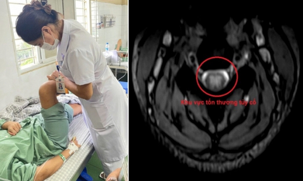 Hít 15 quả bóng cười, nữ sinh bị liệt 2 chân, tổn thương thần kinh