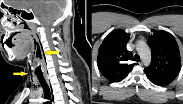 Khí quản người đàn ông 'phát nổ' vì thói quen phổ biến của nhiều người