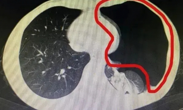 Chàng trai 25 tuổi bị thủng phổi, biết nguyên nhân, bác sĩ ngao ngán: Sao làm mạnh cỡ đó!?