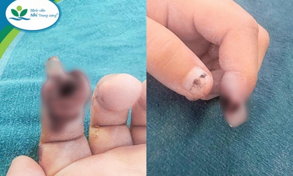 Bé gái 3 tuổi ở Hà Nội bị đứt rời búp ngón tay do kẹp vào cửa kính thuỷ lực ở siêu thị