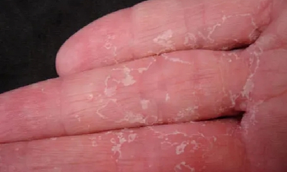 Tại sao da tay bị bong tróc khi chuyển mùa?