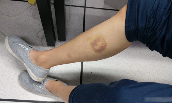 Xuất hiện vết bầm tím ở bắp chân, cậu bé 13 tuổi mắc căn bệnh 'đáng sợ hơn cả HIV/AIDS'