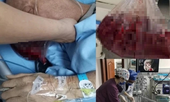 Người đàn ông nôn ra hơn 2 lít máu trong 5 phút, bác sĩ cảnh báo: 4 thói quen ăn uống 'phá nát' dạ dày