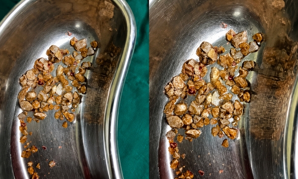 Nam kỹ sư 35 tuổi nhập viện vì sỏi chất đầy trong thận sau khi bỏ trà sữa, uống thứ nước lành mạnh để giảm cân
