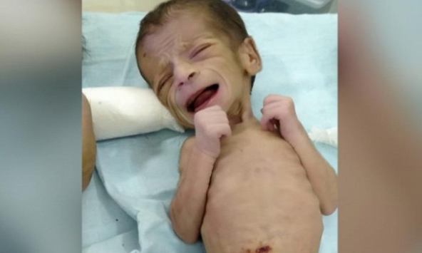 Bé gái sơ sinh bị chôn sống tại Ấn Độ được giải cứu