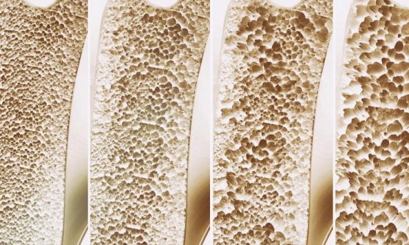 Phát hiện thụ thể “công tắc” ẩn có thể làm thay đổi cuộc chiến chống loãng xương