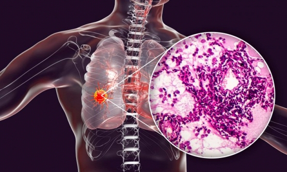 Tình trạng viêm có thể là “mồi lửa” khởi phát ung thư phổi ở giai đoạn sớm